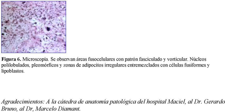 Núcleos polilobulados, pleomórficos y zonas de adipocitos irregulares