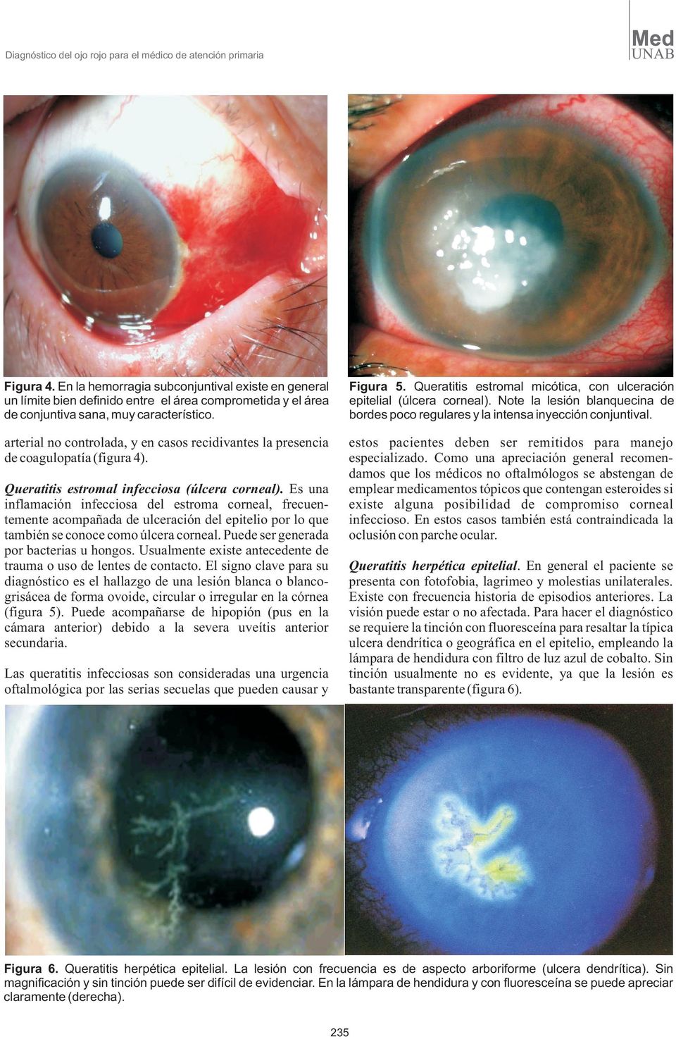 Queratitis estromal micótica, con ulceración epitelial (úlcera corneal). Note la lesión blanquecina de bordes poco regulares y la intensa inyección conjuntival.