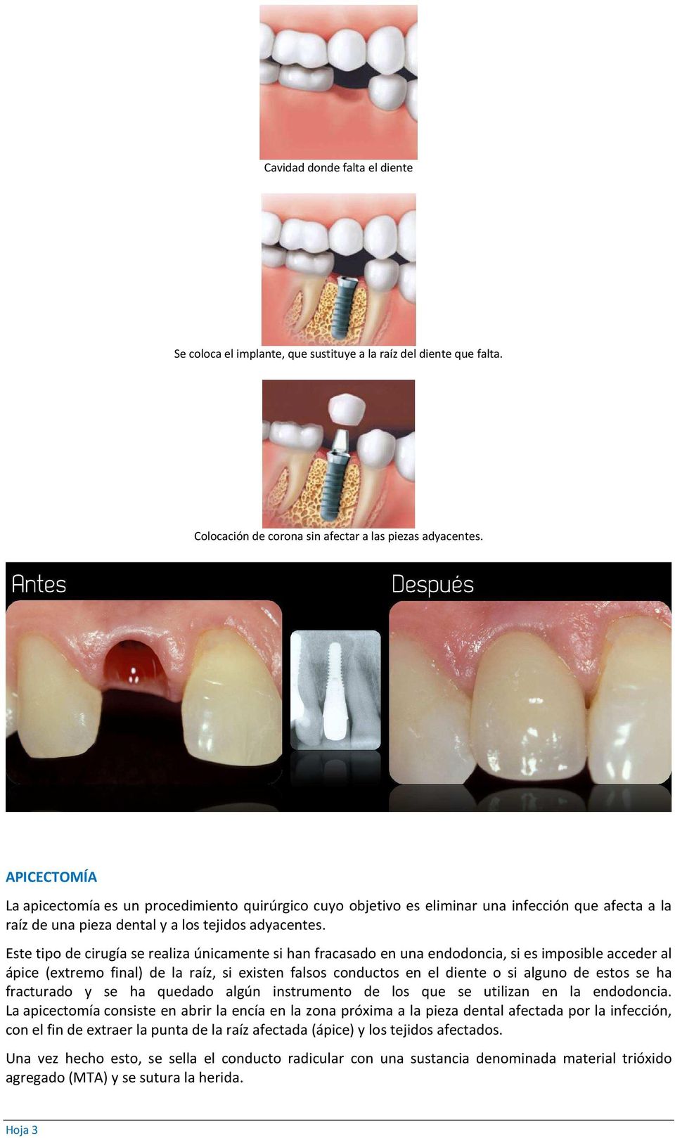 Este tipo de cirugía se realiza únicamente si han fracasado en una endodoncia, si es imposible acceder al ápice (extremo final) de la raíz, si existen falsos conductos en el diente o si alguno de