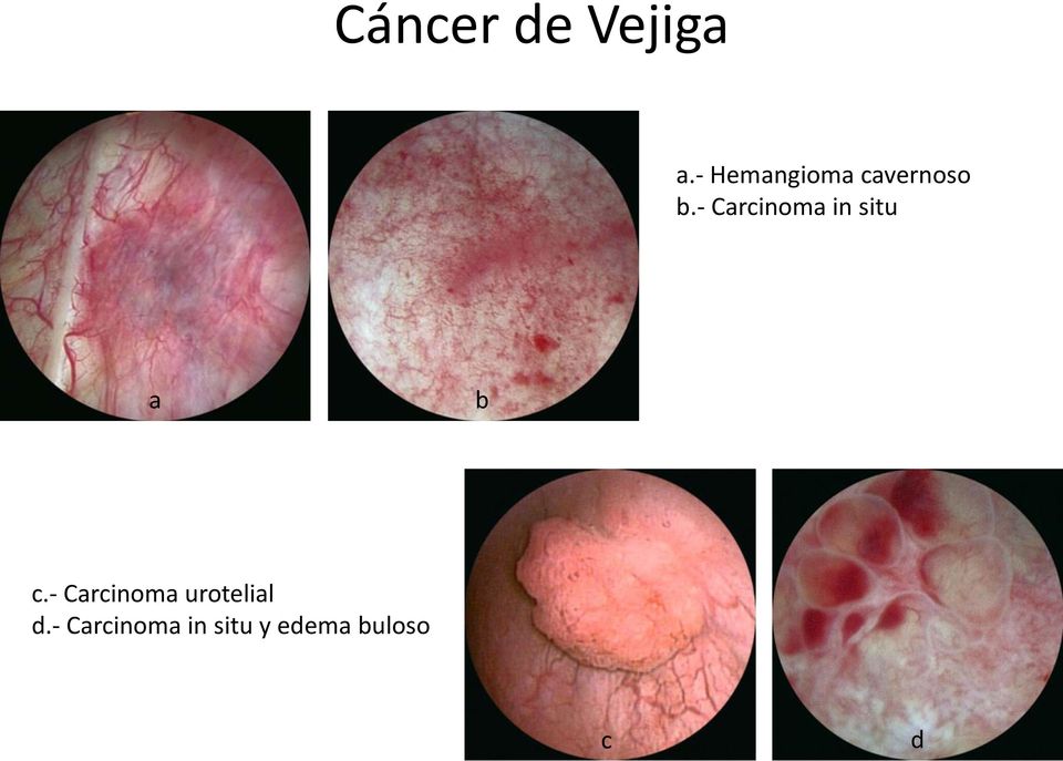 - Carcinoma urotelial d.