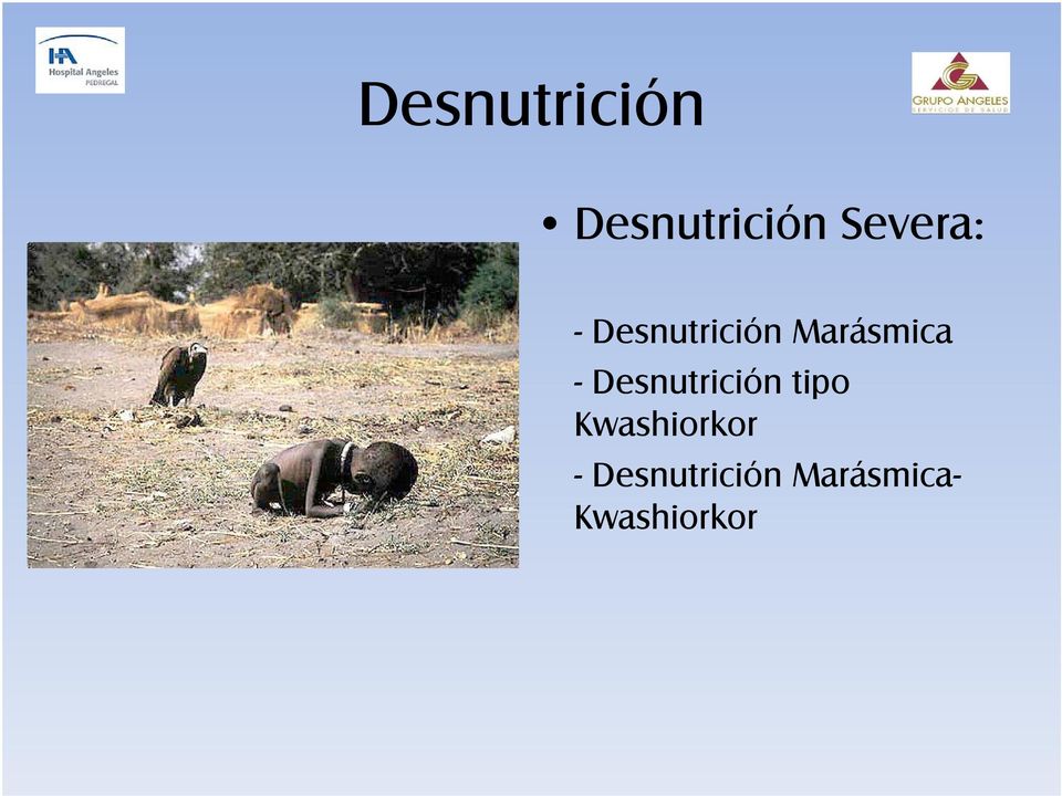 Marásmica - Desnutrición tipo