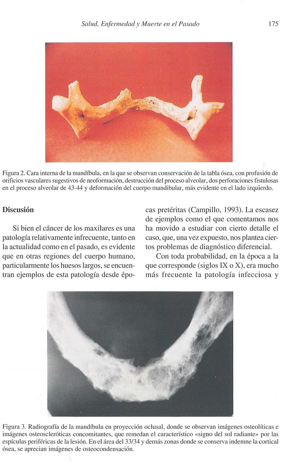 perforaciones fistulosas en el proceso alveolar de 43-44 y deformación del cuerpo mandibular, más evidente en el lado izquierdo.