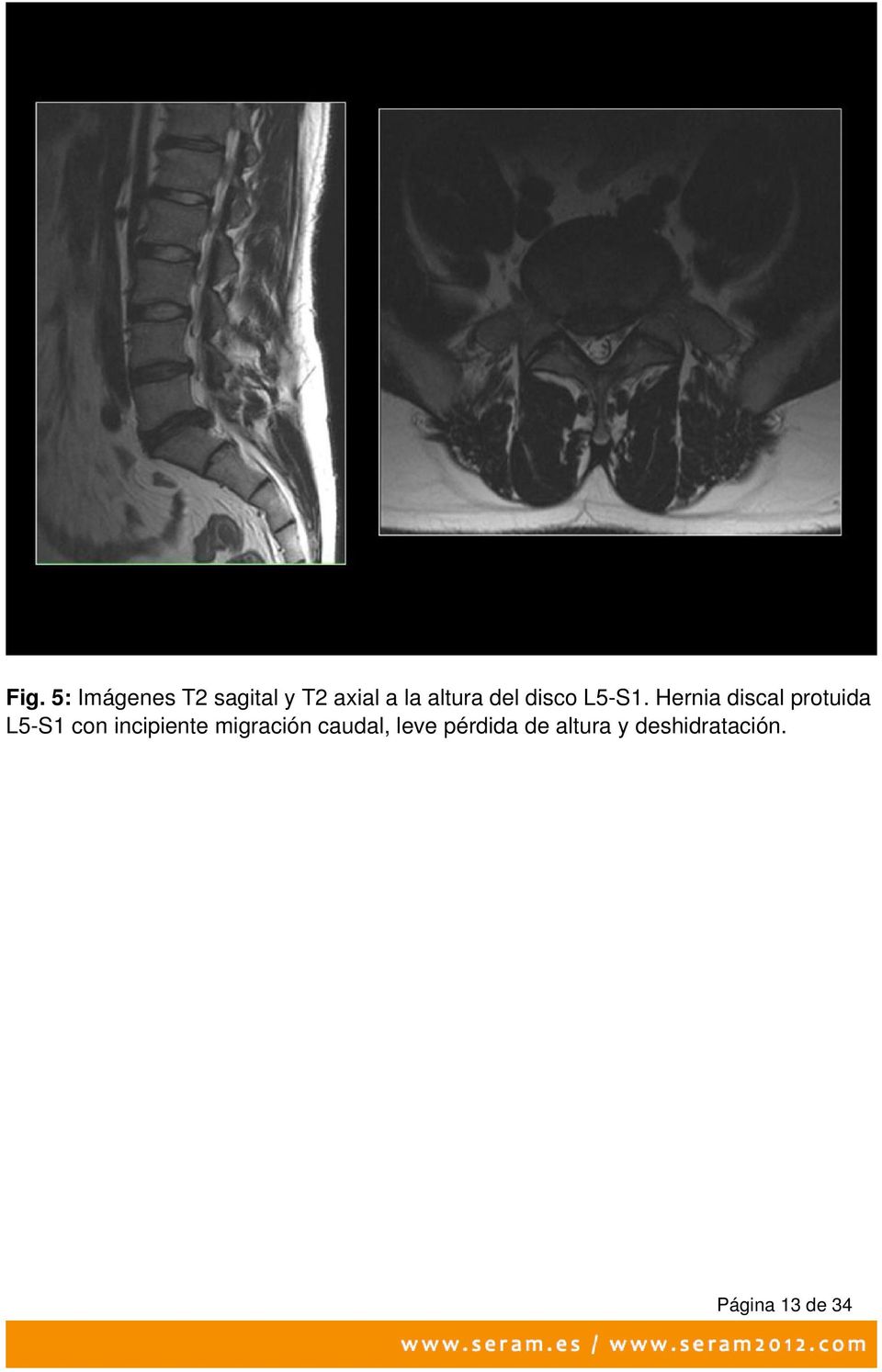 Hernia discal protuida L5-S1 con incipiente