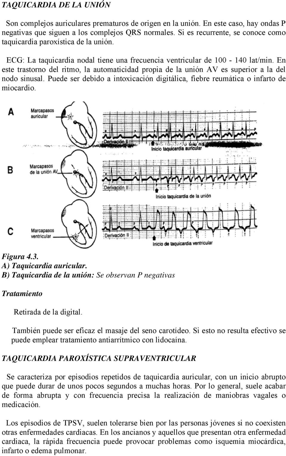 En este trastorno del ritmo, la automaticidad propia de la unión AV es superior a la del nodo sinusal. Puede ser debido a intoxicación digitálica, fiebre reumática o infarto de miocardio. Figura 4.3.