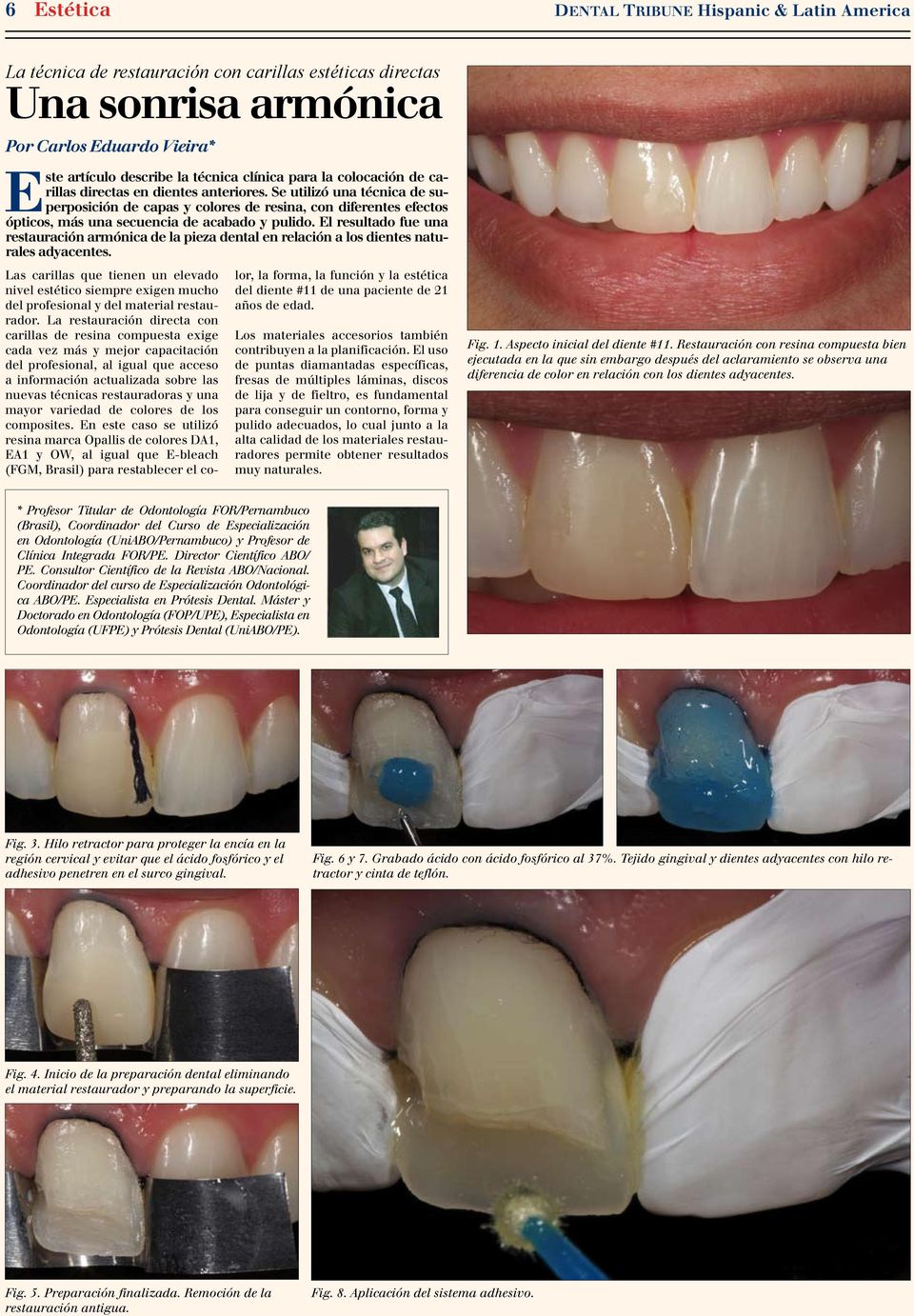 El resultado fue una restauración armónica de la pieza dental en relación a los dientes naturales adyacentes.