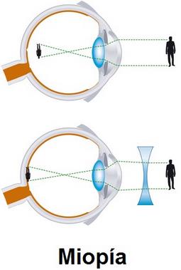 EMETROPÍA: Un ojo normal con acomodación relajada produce la imagen de un objeto colocado en el infinito sobre su plano focal, que se encuentra aproximadamente a 24 mm detrás del vértice de la córnea.
