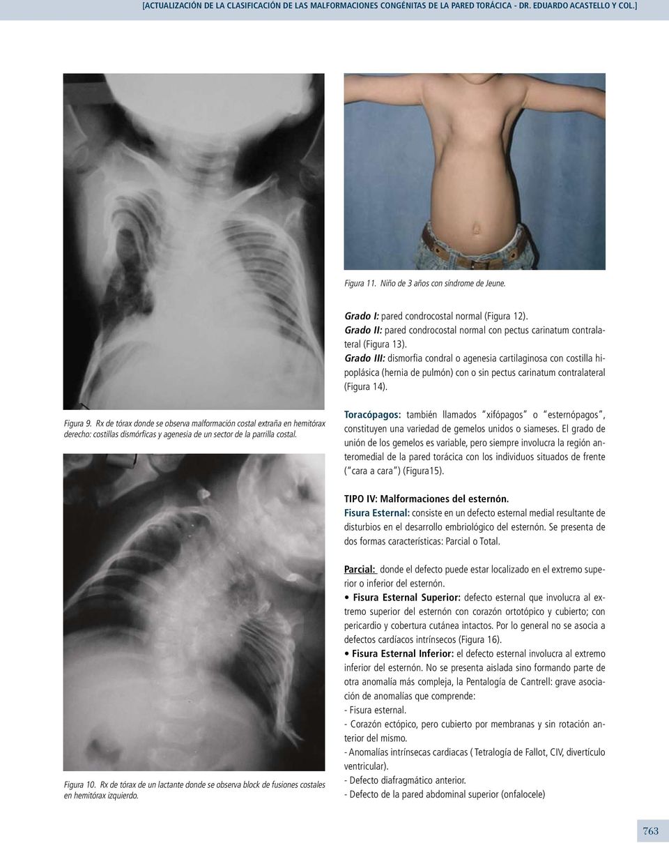 Grado III: dismorfia condral o agenesia cartilaginosa con costilla hipoplásica (hernia de pulmón) con o sin pectus carinatum contralateral (Figura 14). Figura 9.
