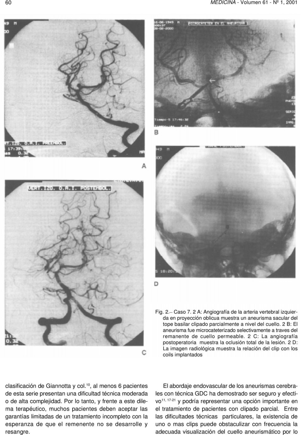 2 B: El aneurisma fue microcateterizado selectivamente a traves del remanente de cuello permeable. 2 C: La angiografía postoperatoria muestra la oclusión total de la lesión.