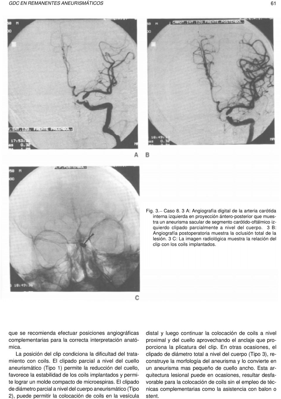 del cuerpo. 3 B: Angiografía postoperatoria muestra la oclusión total de la lesión. 3 C: La imagen radiológica muestra la relación del clip con los coils implantados.