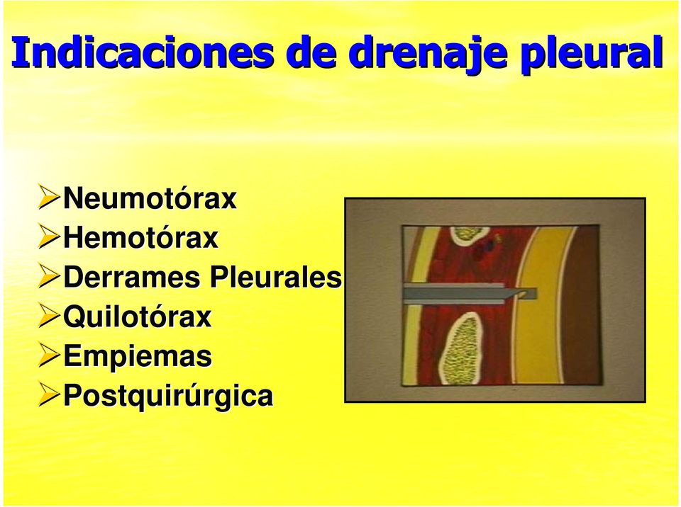Hemotórax Derrames
