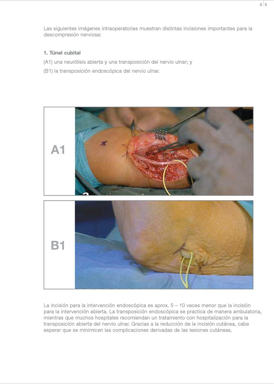 A1 B1 La incisión para la intervención endoscópica es aprox. 5 10 veces menor que la incisión para la intervención abierta.