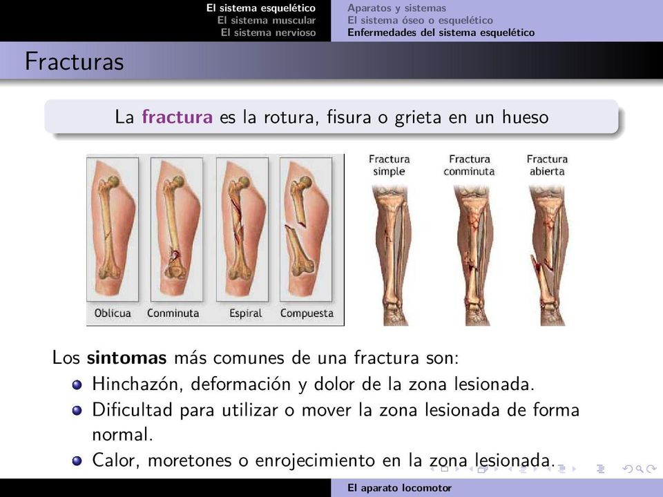 comunes de una fractura son: Hinchazón, deformación y dolor de la zona lesionada.