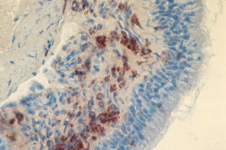 Eosinophils (EG2+ cells) in biopsies of asthmatics Bronchial mucosa Nasal mucosa