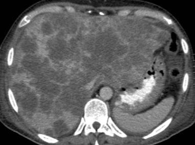 Metástasis Tumores hepáticos malignos más frecuentes. + frec: ADC colon. Múltiples (+ frecuente) Si lesión única: sólida, hipodensa, bien delimitada con realce periférico tenue.