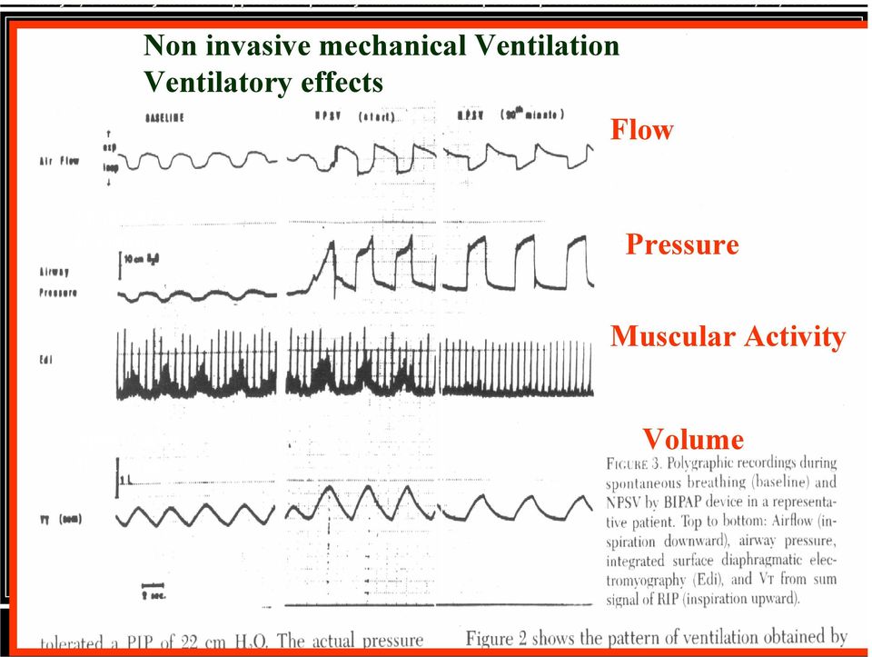 Non invasive mechanical Ventilation Ventilatory effects Flow