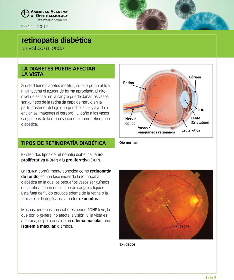 El daño a los vasos sanguíneos de la retina se conoce como retinopatía diabética.