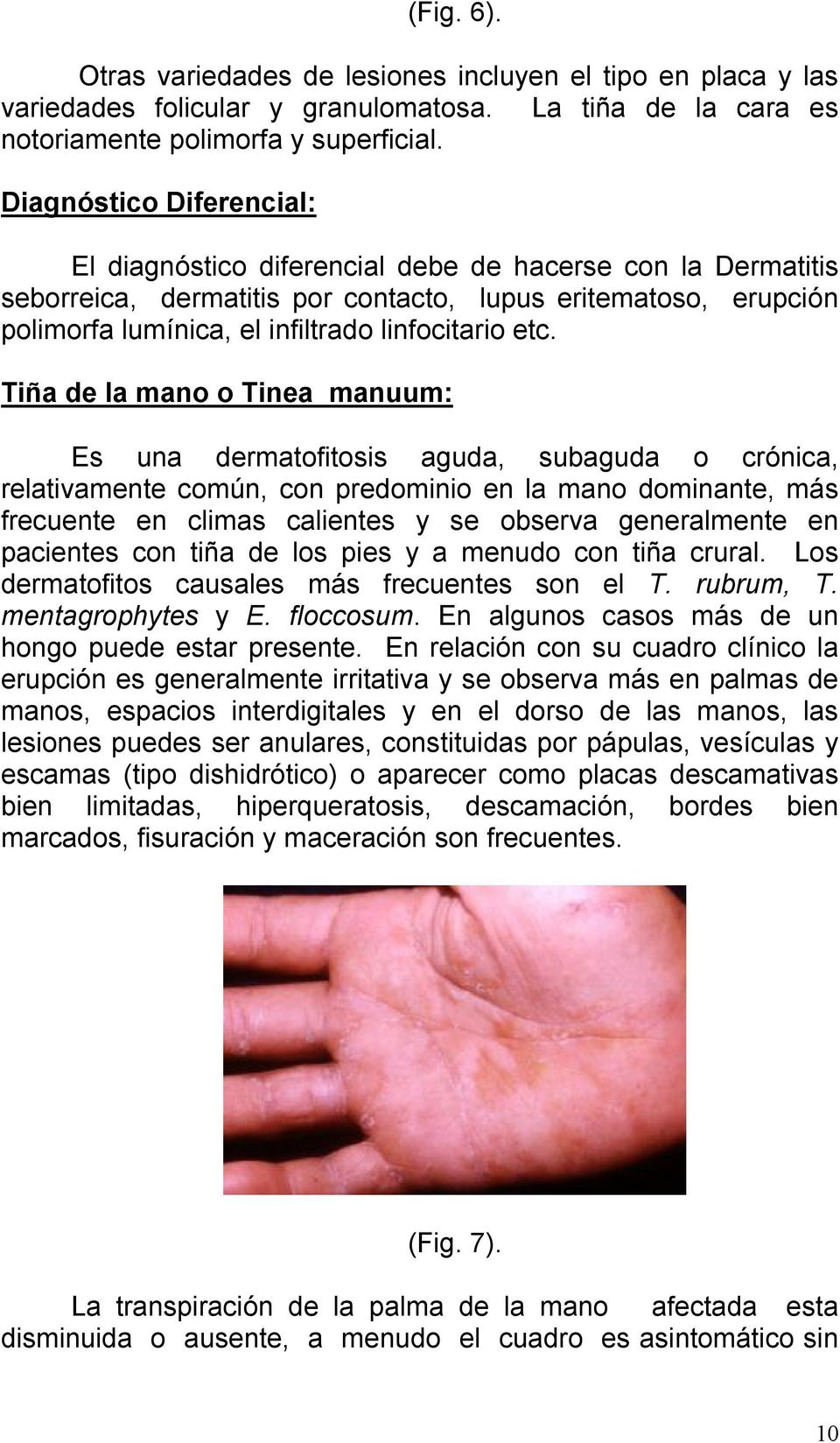 etc. Tiña de la mano o Tinea manuum: Es una dermatofitosis aguda, subaguda o crónica, relativamente común, con predominio en la mano dominante, más frecuente en climas calientes y se observa