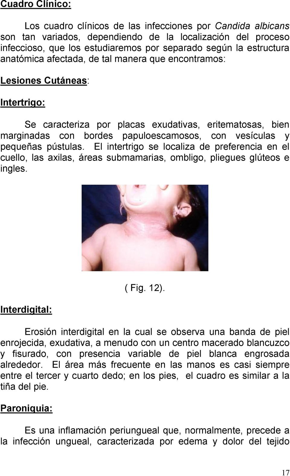 vesículas y pequeñas pústulas. El intertrigo se localiza de preferencia en el cuello, las axilas, áreas submamarias, ombligo, pliegues glúteos e ingles. Interdigital: ( Fig. 12).