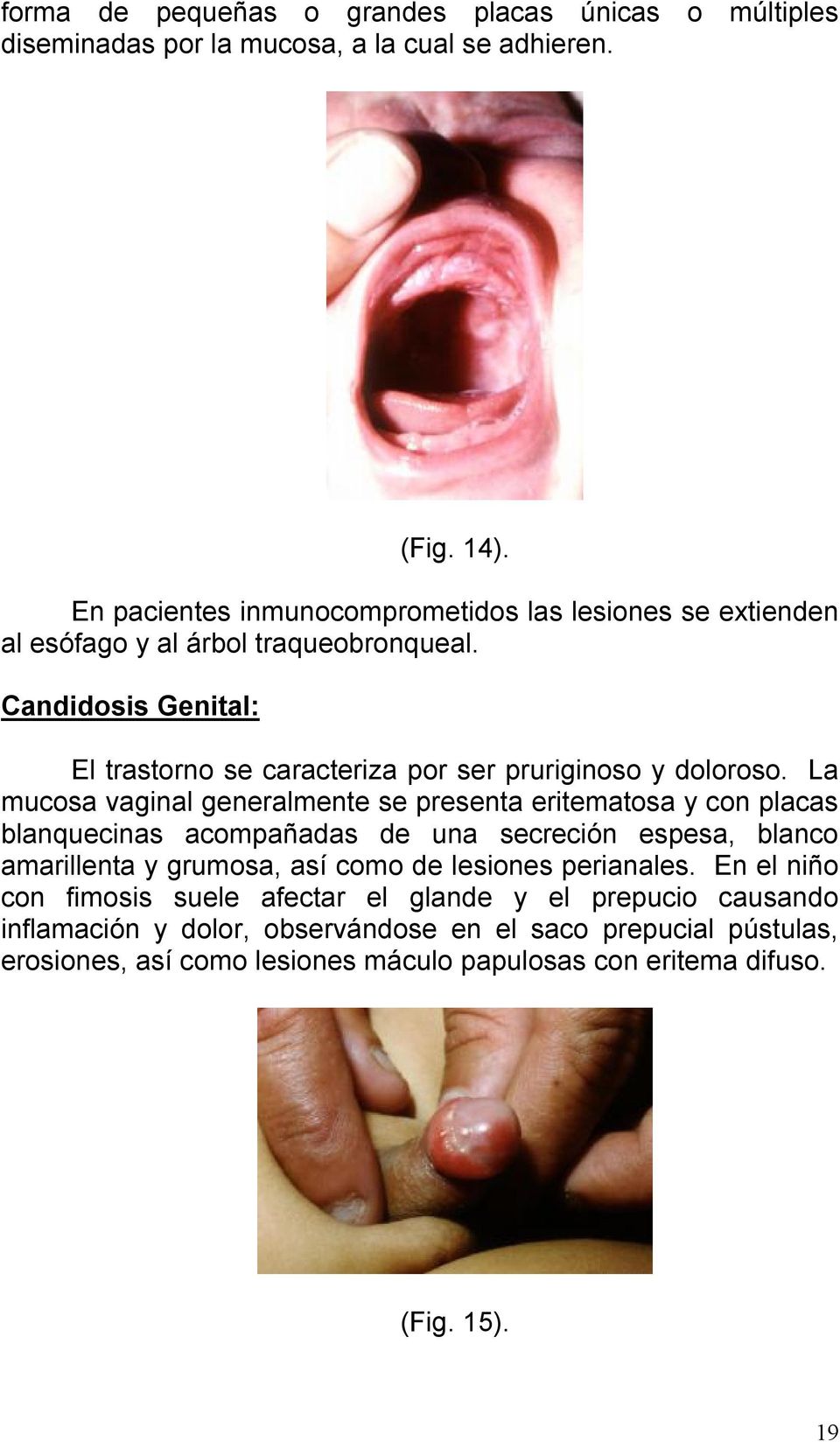 Candidosis Genital: El trastorno se caracteriza por ser pruriginoso y doloroso.