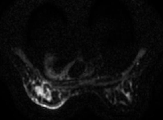 CASO CLINICO Se realiza RMN mamaria: Lesión extensa que ocupa la totalidad del cuadrante inferoexterno de la mama izquierda (desde radial 3 hasta el radial 6).