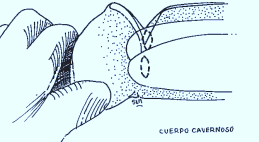 si el shunt no se cierra espontáneamente al cabo del tiempo. (fig. 14) Se practica una incisión transversal en el dorso del glande a 1 cm del surco balanoprepucial.