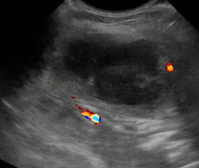 Absceso ganglionar Imagen hipoecogénica con zonas anecoicas centrales