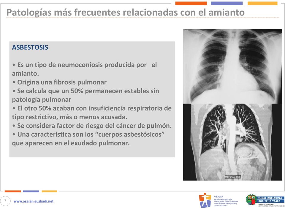 Origina una fibrosis pulmonar Se calcula que un 50% permanecen estables sin patología pulmonar El otro 50%