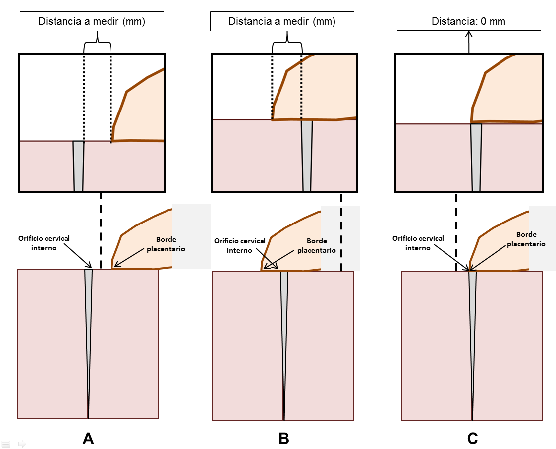 Figuras Figura 1. Esquema que representa la relación del borde placentario con el orificio cervical interno tras la evaluación ecográfica endovaginal. A.