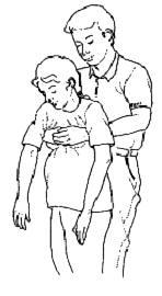Figura Nº 20: Maniobra de Heimlich para Víctimas Embarazadas u Obesas Es muy importante que la persona que realiza la maniobra presione sobre la zona que se indica en la figura anterior y no sobre la