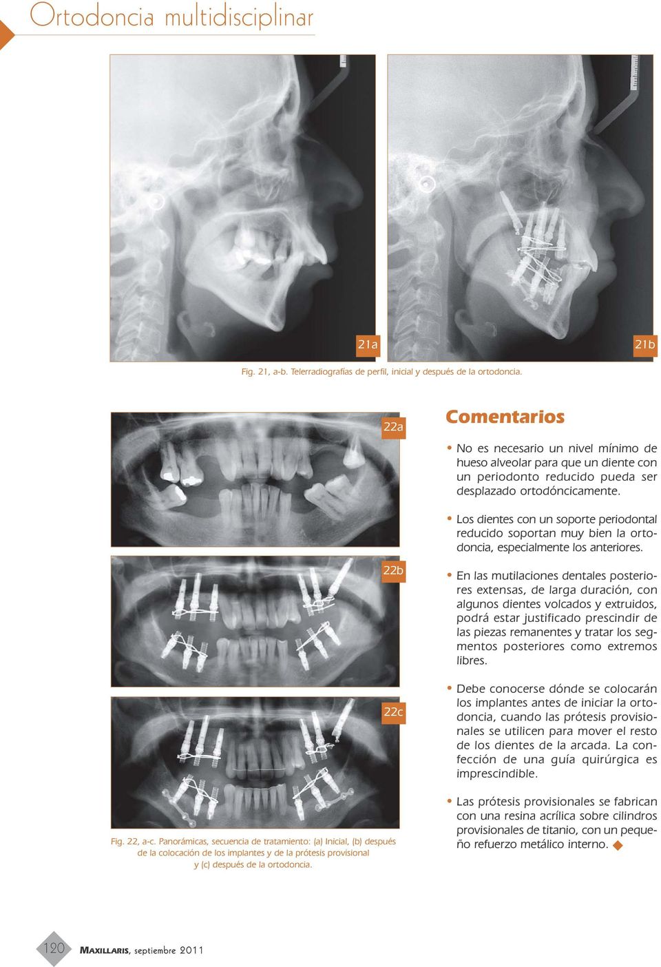Los dientes con un soporte periodontal reducido soportan muy bien la ortodoncia, especialmente los anteriores. Fig. 22, a-c.