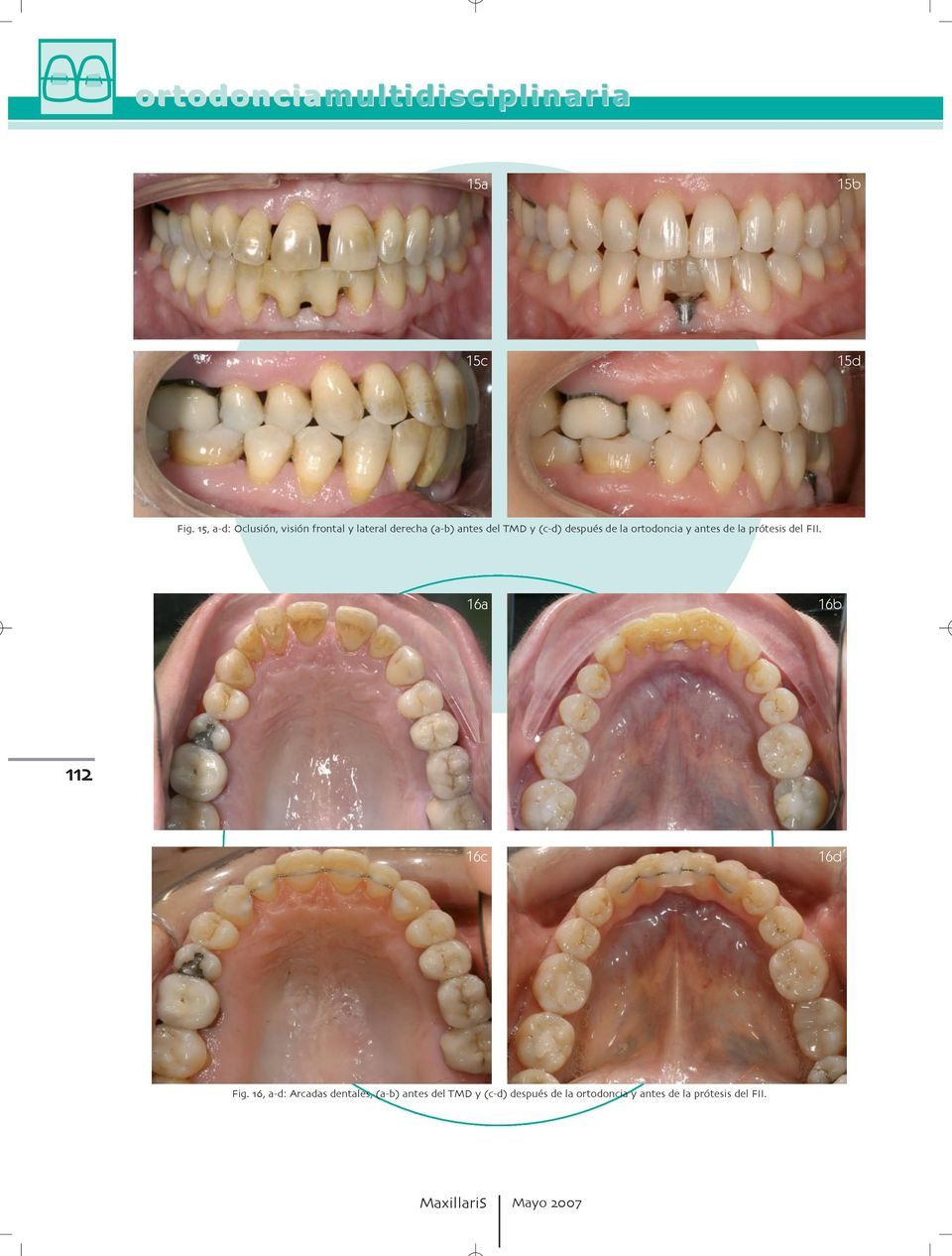 prótesis del FII 16a 16b 16c 16d Fig a d: Arcadas dentales  prótesis
