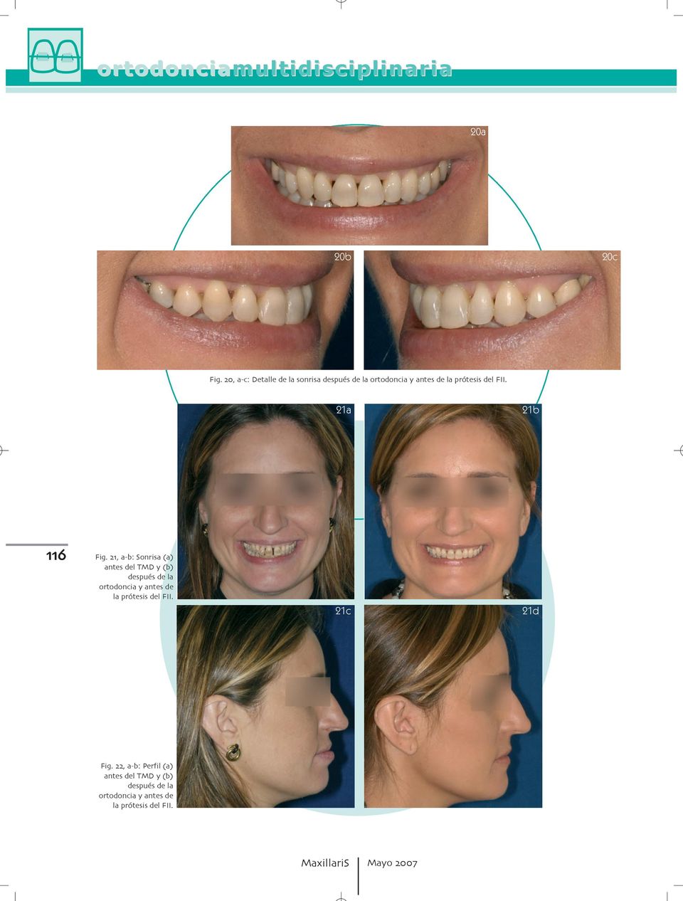 después de la ortodoncia y antes de la prótesis del FII 21c 21d Fig a b: