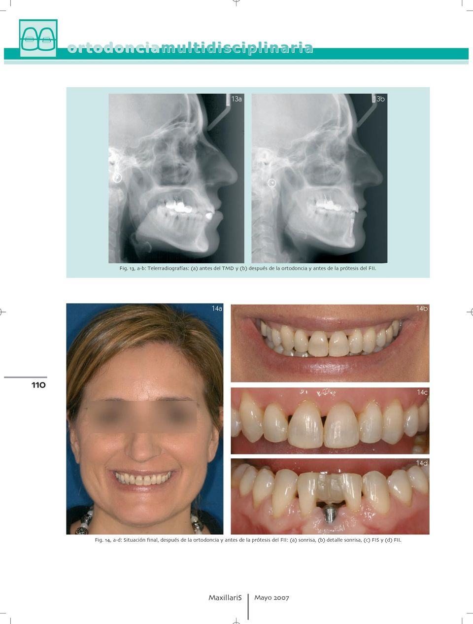 14c 14d Fig a d: Situación final después de la ortodoncia y antes
