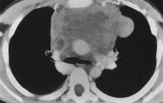 LINFOMA HODGKIN LINFOMA Masa con bordes lobulados en mediastino anterior Adenopatías mediastinales e