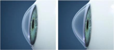 Visión y defectos de la visión Defectos de la visión HIPERMETROPIA: El globo ocular de un hipermétrope es muy corto, por lo que el cristalino proyecta la imagen más atrás de la retina, produciendo