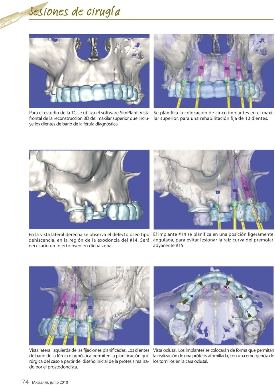En la vista lateral derecha se observa el defecto óseo tipo dehiscencia, en la región de la exodoncia del #14. Será necesario un injerto óseo en dicha zona.