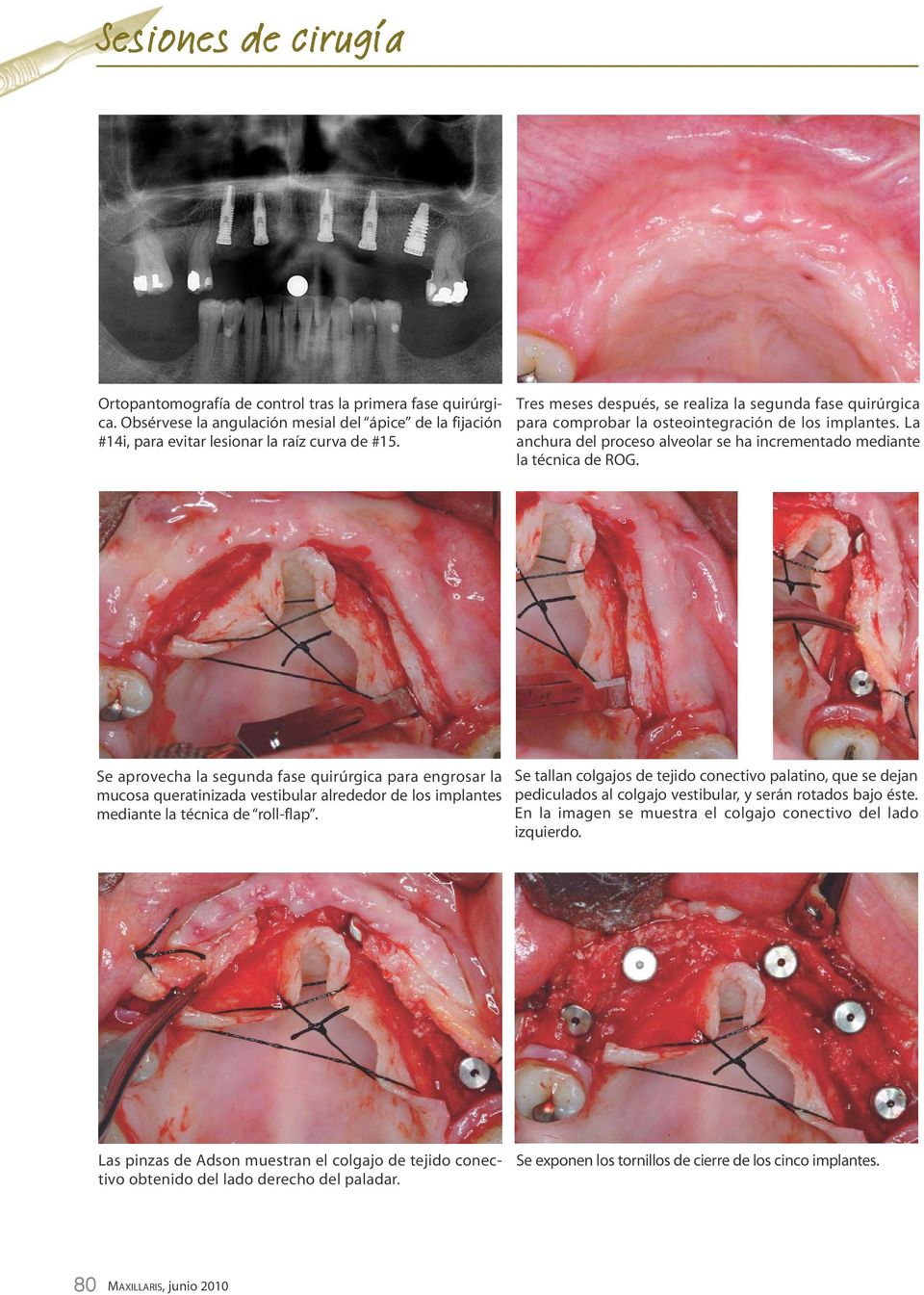 Se aprovecha la segunda fase quirúrgica para engrosar la mucosa queratinizada vestibular alrededor de los implantes mediante la técnica de roll-flap.