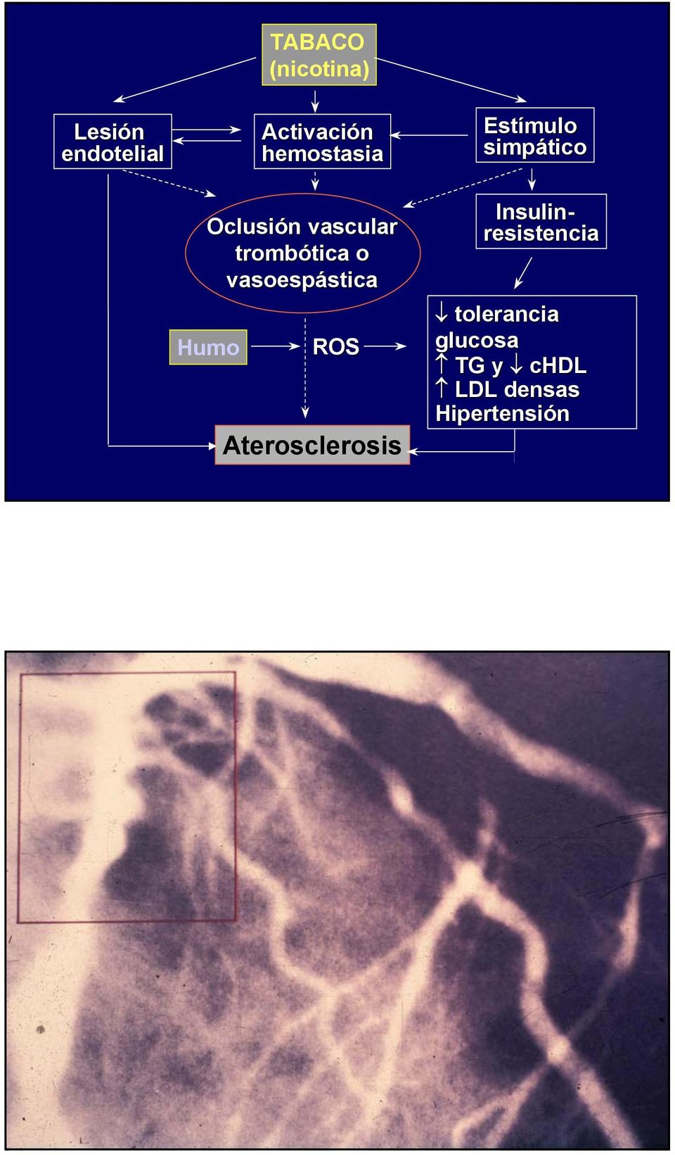 vasoespástica Humo ROS Aterosclerosis Estímulo