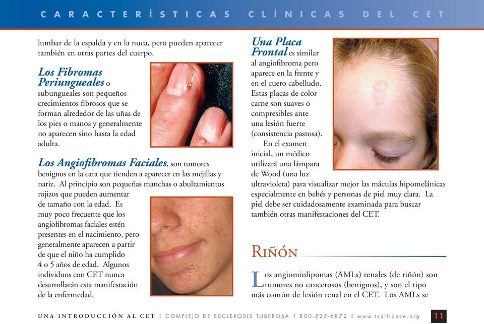 Los Angiofibromas Faciales, son tumores benignos en la cara que tienden a aparecer en las mejillas y nariz.