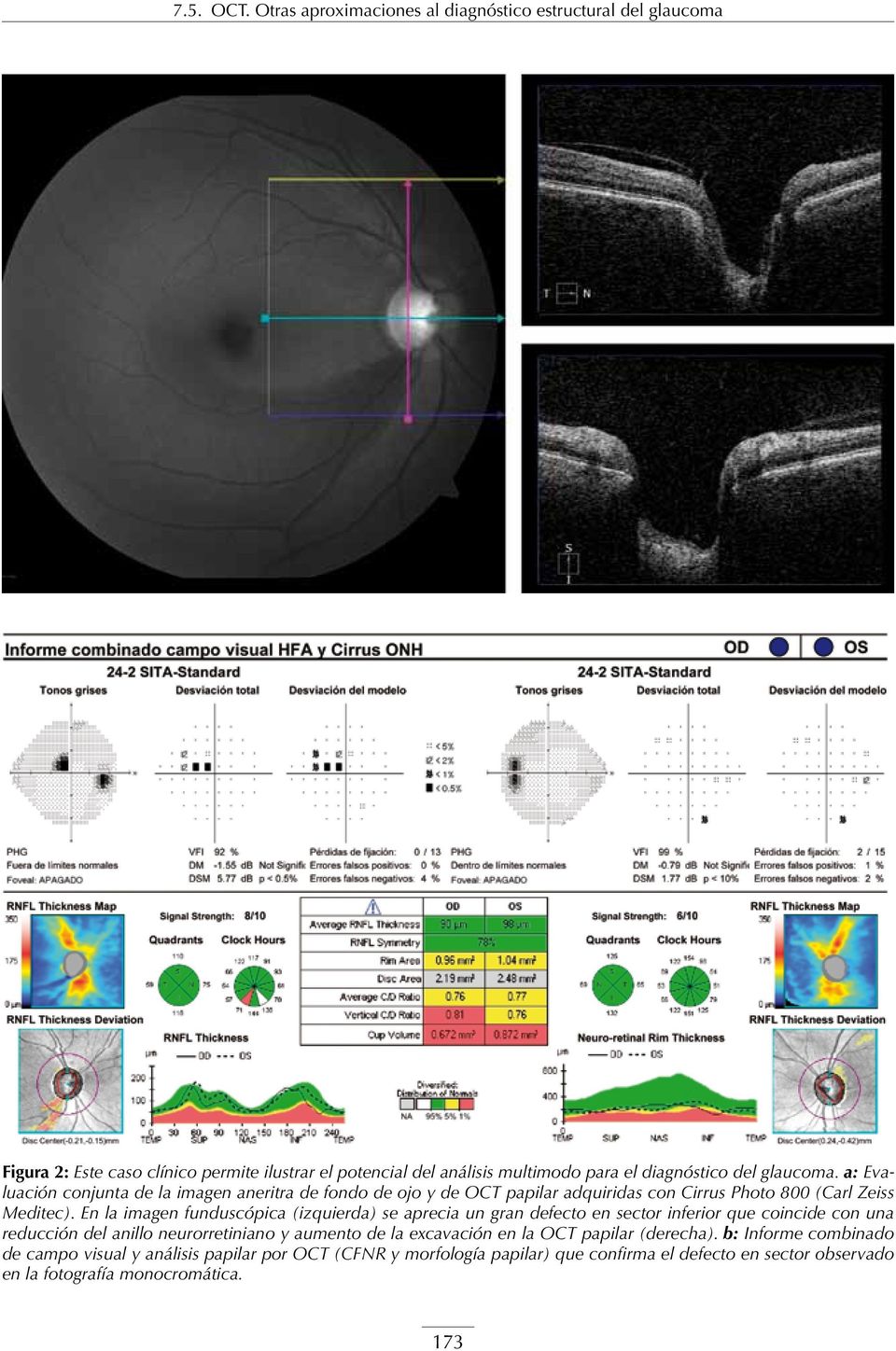 glaucoma. a: Evaluación conjunta de la imagen aneritra de fondo de ojo y de OCT papilar adquiridas con Cirrus Photo 800 (Carl Zeiss Meditec).