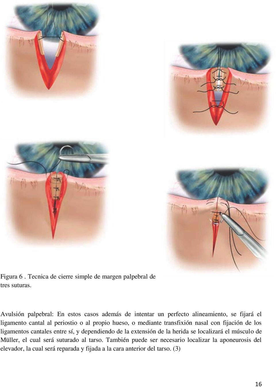 hueso, o mediante transfixión nasal con fijación de los ligamentos cantales entre sí, y dependiendo de la extensión de la herida se
