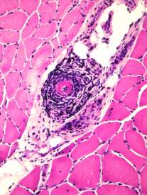 Poliangeitis microscòpica (PAM) Afectación cutánea ( ) - Vénulas postcapilares (púrpura palpable) - Arteriolas subcutáneas (nódulos