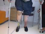 ACUERDO 029 DE 2011-CRES AYUDAS TECNICAS INCLUIDAS EN EL POS Prótesis de miembro inferiores Estructuras de soporte para caminar Órtesis Ortopédicas Caminadores Audífonos Implante