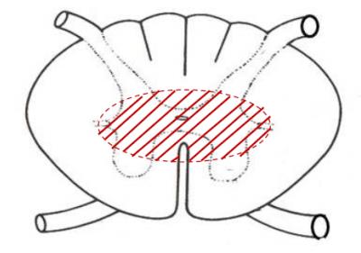 Todos los signos se presentan en porciones espinales inferiores al segmento medular afectado. 2.