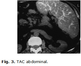 Planteamiento nosológico: neumonía de base pulmonar derecha; esclerosis unilateral amiotrófica. Impresión diagnóstica: esclerosis unilateral amiotrófica agudizada por neumonía de base derecha.