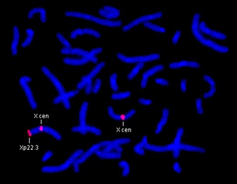 Azul: tinción con DAPI, específico para DNA 4',6-Diamidino-2-phenylindole Célula en metafase que se ha hibridado con una sonda para la deficiencia de esteroide-sulfatasa, causada por una
