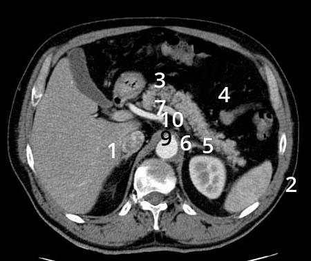 13 Anatomía normal del tac abdominal E. NIVEL Nº 4 Figura 29. En este corte se observa (1) hígado, (2) bazo, (3) polos superiores de ambos riñones, (4) páncreas y (5) el ángulo esplénico del colon.