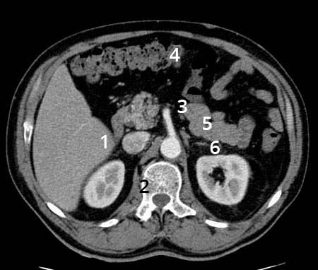 14 Anatomía normal del tac abdominal G. NIVEL Nº 6 Figura 31. Este corte pasa a nivel de (1) la confluencia esplenoportal, rodeada hacia anterior por (2) el cuerpo y cola del páncreas.