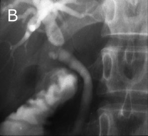 29 Patología de la vía biliar Figura 60. Síndrome de Mirizzi. Figura 61. A- Operación que muestra la pared de la vesícula se ha abierto mostrando el cálculo.