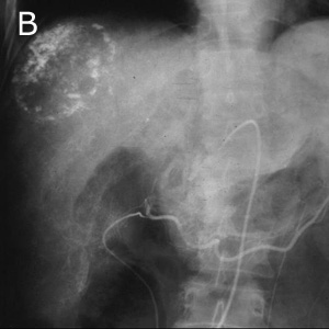 40 Patología del hígado Figura 81. A- TAC abdominal: sin contraste intravenoso. Se observa una lesión hipodensa, redondeada en el lóbulo derecho (tiene la misma densidad que la vena porta).